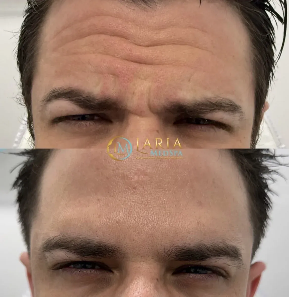 LARIA MedSpa facial rejuvenation before and after